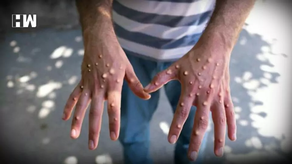 Monkeypox
