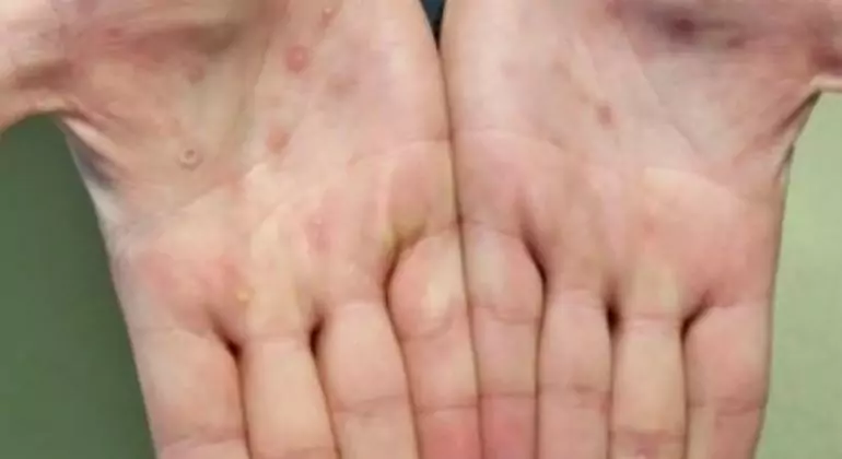 Monkeypox lesions often appear on the palms of hands. Monkeypox lesions often appear on the palms of hands.